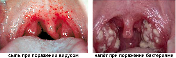 Волдыри на задней стенке горла: причины образования красных и белых пузырьков 