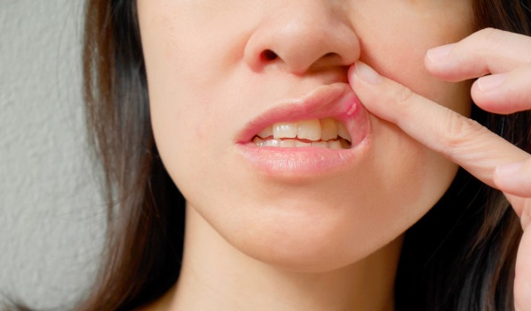 Воспаление слизистой оболочки рта или стоматит 