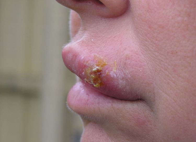 Вскочила на губе простуда — причины и лечение 