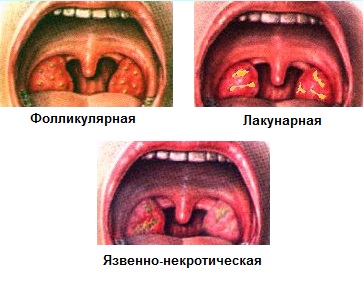 Язвенно-некротическая ангина: отличие от других видов ангины, причины заболевания, виды лечения 