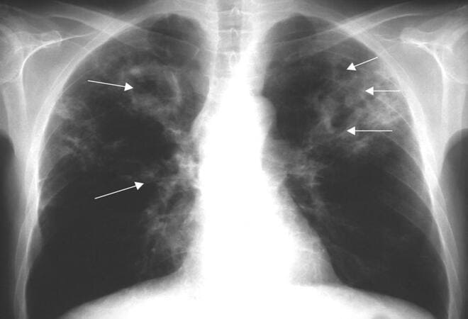 Заразен ли инфильтративный туберкулез легких и как лечится 