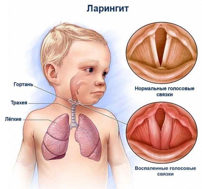 Звонкий кашель у ребенка 