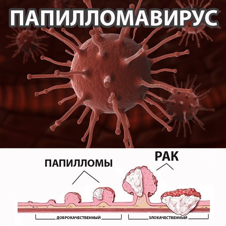 12 мифов о вирусе папилломы человека 