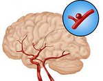 Аневризма сосудов головного мозга 
