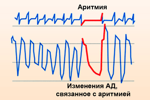 Аритмия сердца - симптомы, лечение 