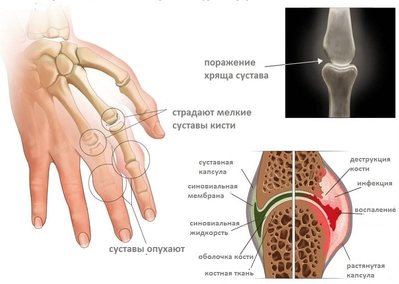 Артрит ревматоидный: лечение современными и народными методами 
