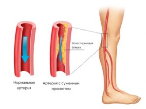 Атеросклероз артерий нижних конечностей — причины, диагностика и лечение 