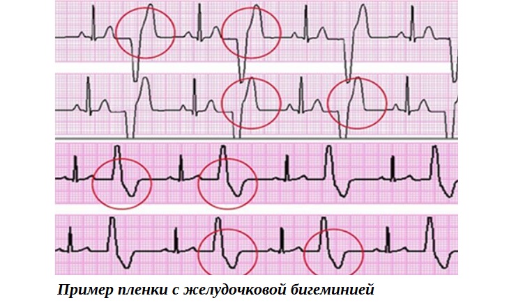 Бигеминия как разновидность внеочередных сокращений 