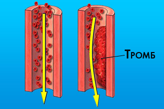 Симптомы и последствия тромба в сердце 