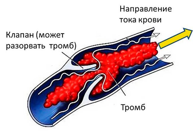 Симптомы закупорки сосудов головного мозга 