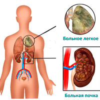 Синдром Гудпасчера: симптомы, диагностика, лечение 