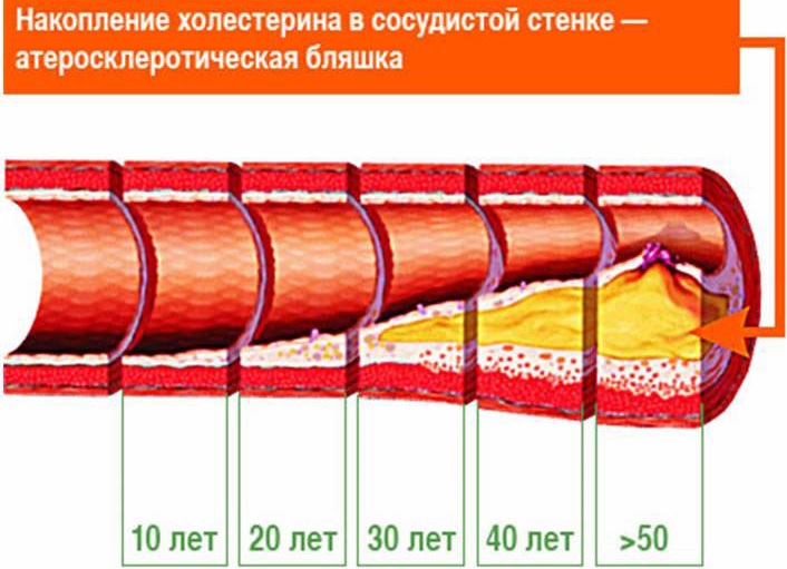 Способы профилактики атеросклероза сосудов 