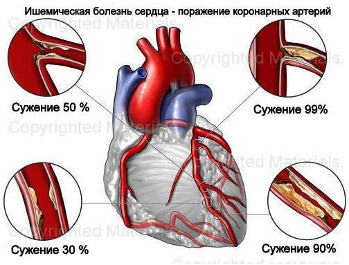 Способы профилактики ИБС 