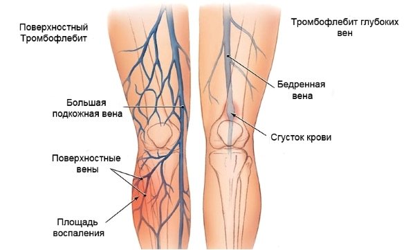 В чем основная разница между варикозом и тромбофлебитом 