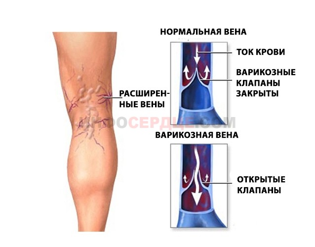 Венозная недостаточность ног: виды, причины, проявления, осложнения, лечение 