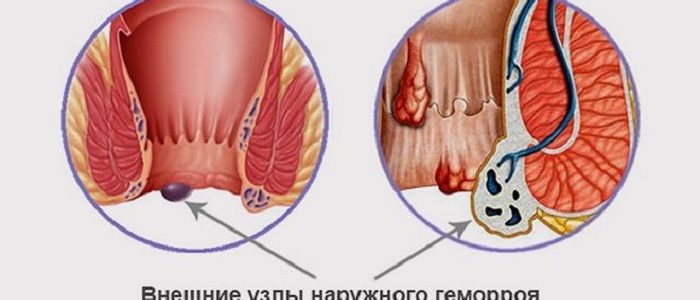 Внешний геморрой 