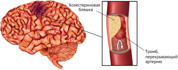 Внутричерепное давление — симптомы и лечение у взрослых 