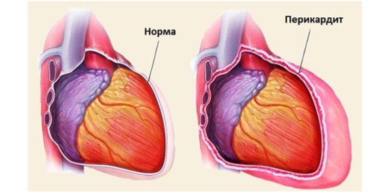 Жидкость в полости перикарда 