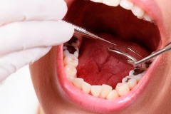 15 лучших способов отбеливания зубов в домашних условиях 