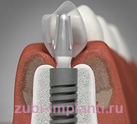 7 названий имплантации зубов по протоколу немедленной нагрузки. Как не запутаться? 
