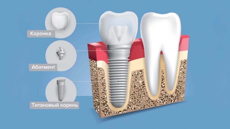 Абатмент на имплант: виды, подвиды и цены, методы установки 