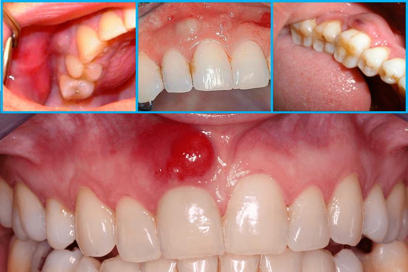 Абсцесс полости рта — острое гнойное воспаление 