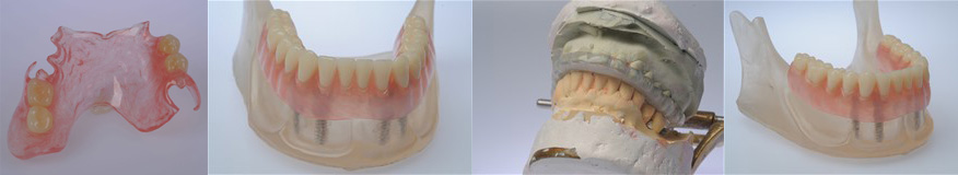Acry-Free — съемные гибкие нейлоновые зубные протезы, мягкие протезы зубов 