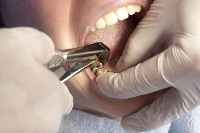 Альвеолит после удаления зуба — лечение разными методами 