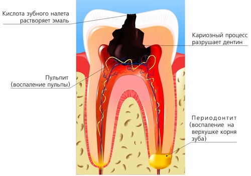 Апикальный Периодонтит-Диагностика И Лечение Острого Апикального Периодонтита 