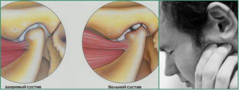 Артроз ВНЧС — симптомы и лечение 
