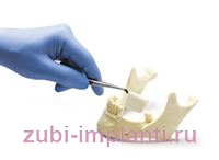 Аугментация — процедура для восстановления костной ткани челюсти 