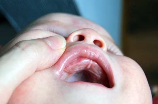 Белые пятнышки или точки на деснах, во рту и на языке у грудничка 