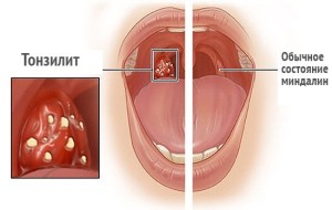 Белые точки на гландах (миндалинах): что это? Причины и лечение 