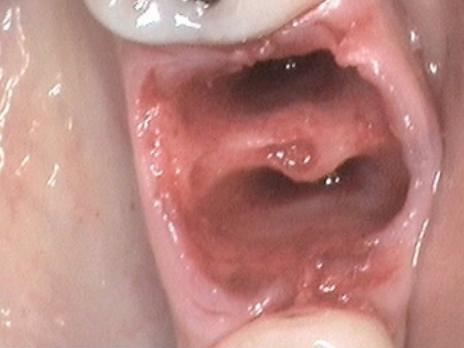 Болит десна после удаления зуба – почему и что делать 