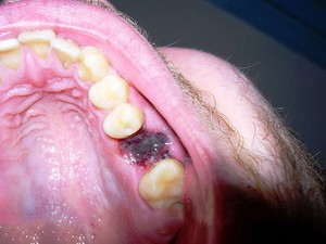 Боль после удаления зуба: сколько дней продолжается 