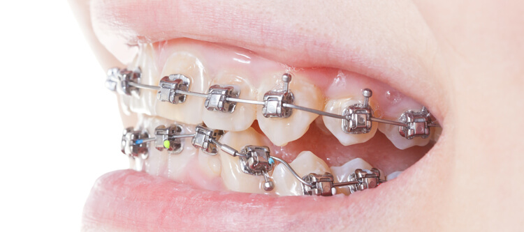 Брекеты на внутреннюю сторону зубов: как поставить и сколько стоят 