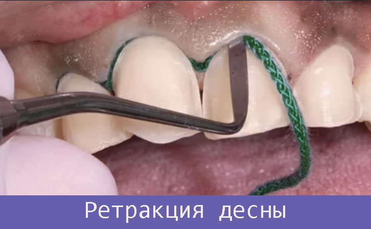 Что такое ретpaкционная нить? Методы ретpaкции, показания, осложнения 