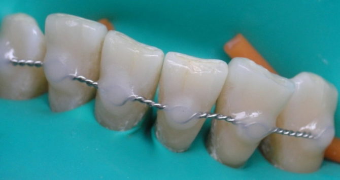 Что такое шинирование подвижных (шатающихся) зубов при пародонтите и пародонтозе 