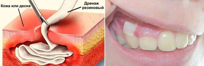 Дренаж в десне: показания, установка и снятие 