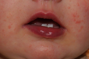Если у ребенка синеют губы, стоит ли паниковать? 