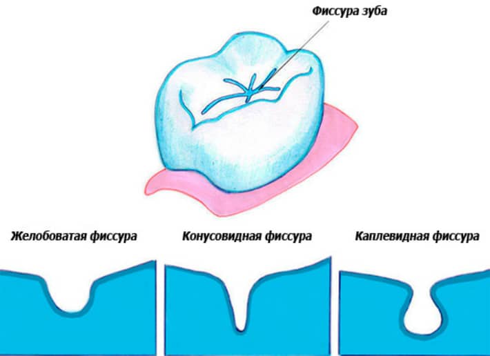 Фиссурный кариес: когда начинать лечение, причины и последствия 