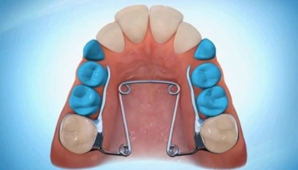 Функции Quad Helix в ортодонтии 