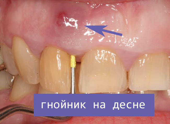 Гнойник на десне: причины возникновения, как лечить 