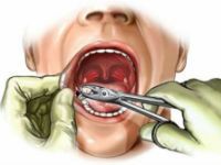 Гной после удаления зуба, как предотвратить 