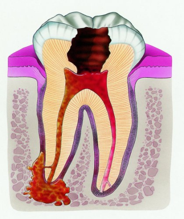 Гранулема зуба: лечение, фото 