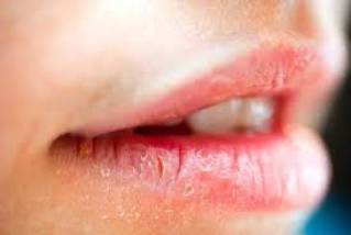 Грибок на губах: фото симптомов, причины развития, методы лечения 