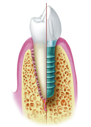 Имплантация зубов «под ключ» 