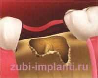 Имплантация зубов при атрофии костной ткани: цены на наращивание 