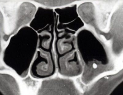 Инородное тело в гайморовой пазухе: способы лечения, симптомы и последствия 