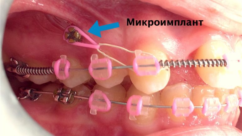 Использование микроимплантов в ортодонтии: сферы применения, отзывы 